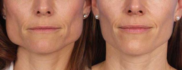 Masseter botox